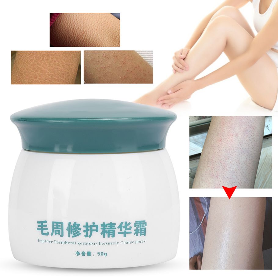 Professional Keratosis Pilaris Body Soothing Chicken Skin Treatment Care 50g