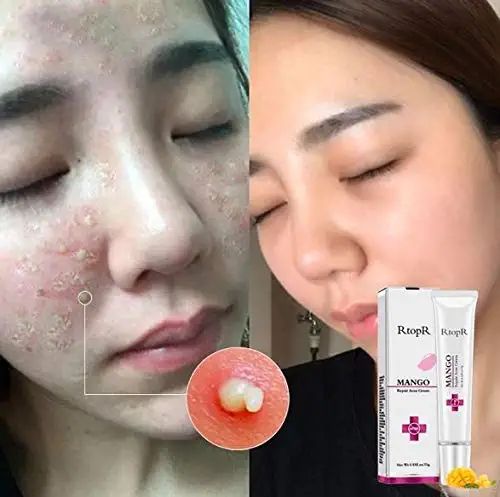 15g Rt0pR Mango Repair Acne c-ream Anti-acne Treatmen